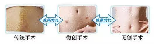 一种“隐形”治疗子宫肌瘤的方法！