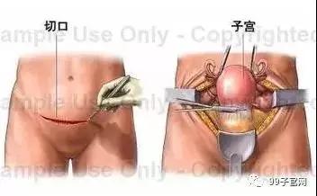 一种“隐形”治疗子宫肌瘤的方法！