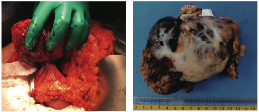 pubmed文献总结,pubmed文献综述类