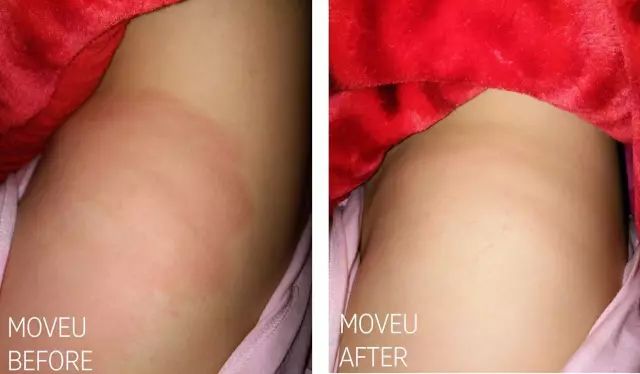 “万用”紫草膏，解决了你多少皮肤烦恼？