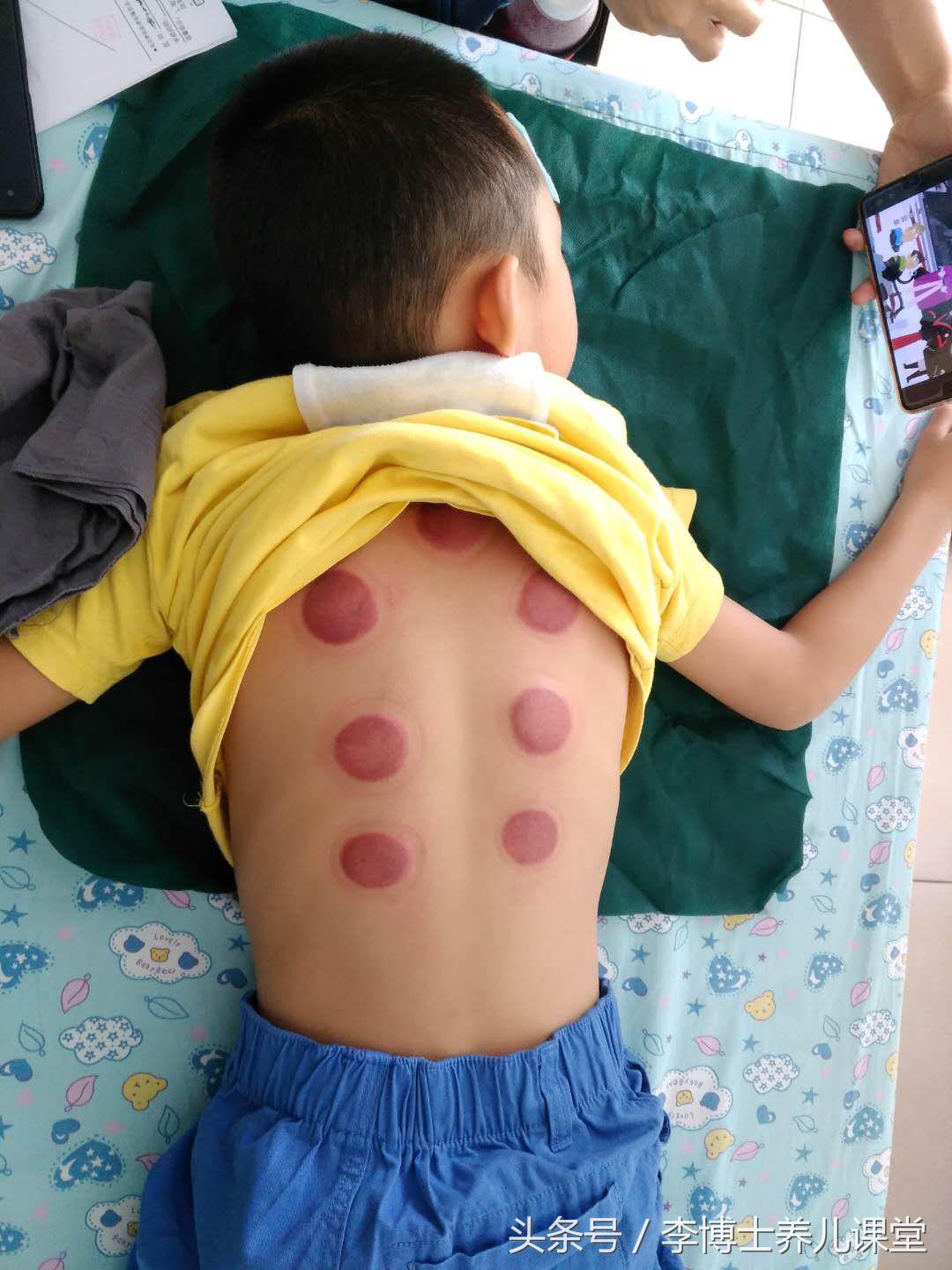 疱疹性咽峡炎和手足口病关注事项,疱疹性咽峡炎手足口哪个更严重