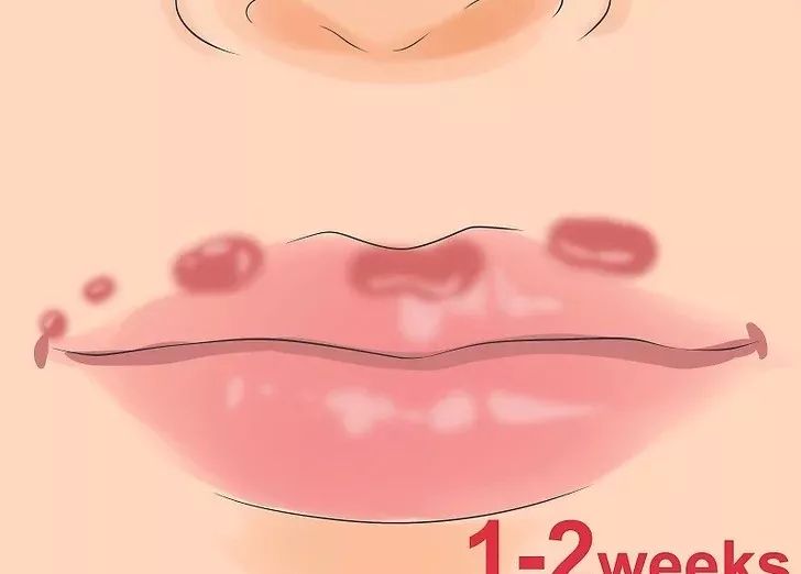 嘴巴上起泡了是怎么回事,嘴巴上起泡了怎么快速消除不用药