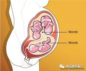 女的要有2个子宫才能生双胞胎吗,不完全双角子宫怀双胎