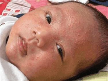 新生儿常见七种皮肤病,新生儿皮肤病中医辨证