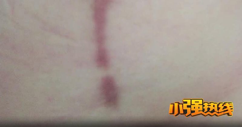 让胸变小的手术如何做,女人把胸部变小手术