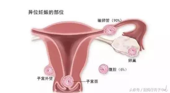 孕期流血是流产的征兆吗,孕期生化流血