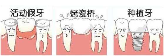 种植牙比假牙好吗,种牙与镶牙费用对比