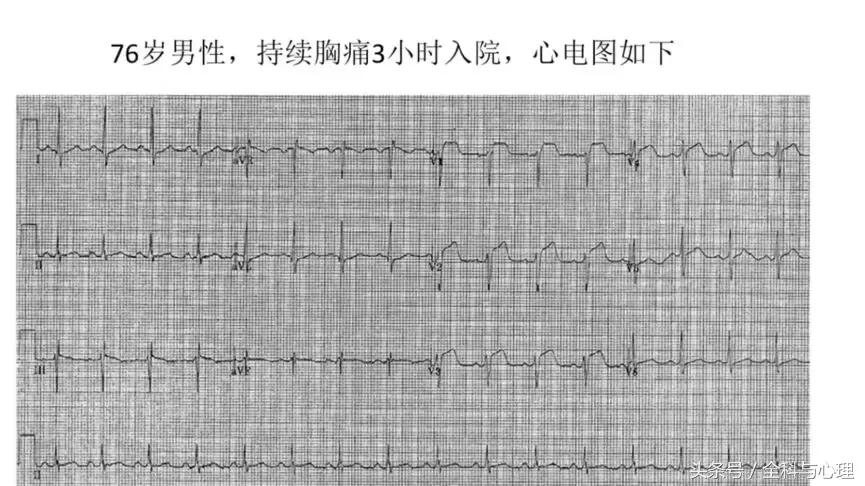 一文读懂心血管疾病,左室心梗和右室心梗