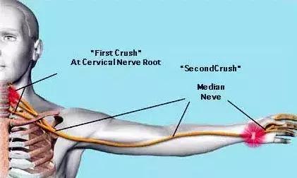 手麻要警惕病变,手麻肩膀痛警惕四种病