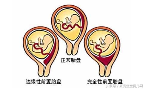 孕期见红会流产吗？有些出血很正常需要关注的是这5种情况！