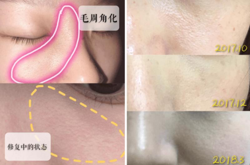 痘痘毛孔角化,小颗粒中颗粒大颗粒有什么不同点