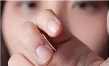 拔手指倒刺感染导致截指,为什么撕手上倒刺会导致截指