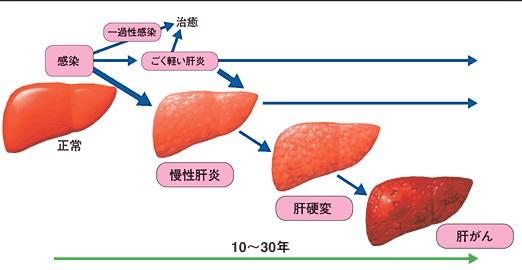 肝炎恶化身体会出现4个异常,肝炎的人养肝比吃药更重要吗