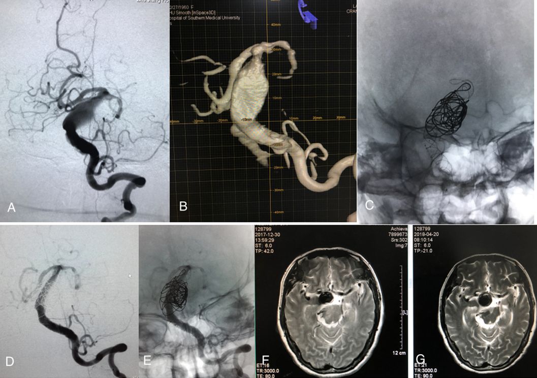 学术快报｜何旭英：椎基底动脉延长扩张症介入治疗的体会