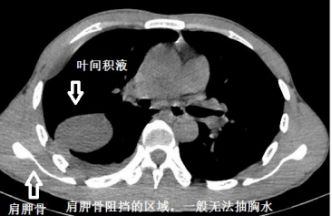 胸水抽了为什么还呼吸困难,胸水抽不出来了怎么回事
