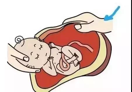 胎儿命悬一线医生托举24分钟救命,脐带脱垂宝宝死亡