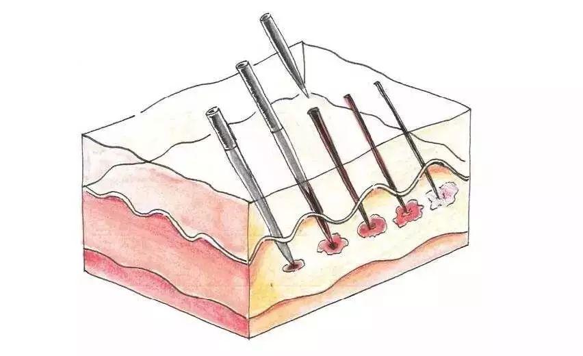 微针值得做吗,口碑最好的微针