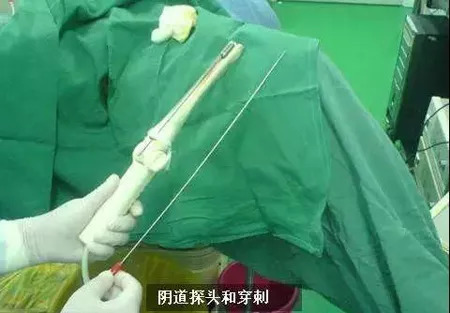 捐卵子骗局,非法集资黑中介