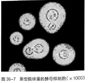 看懂痰涂片的真菌结果就这么简单！