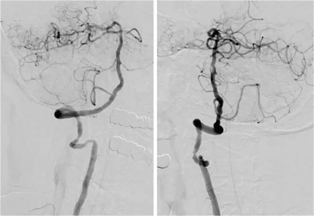 天坛周记,右侧椎动脉v4段较细小怎么治疗
