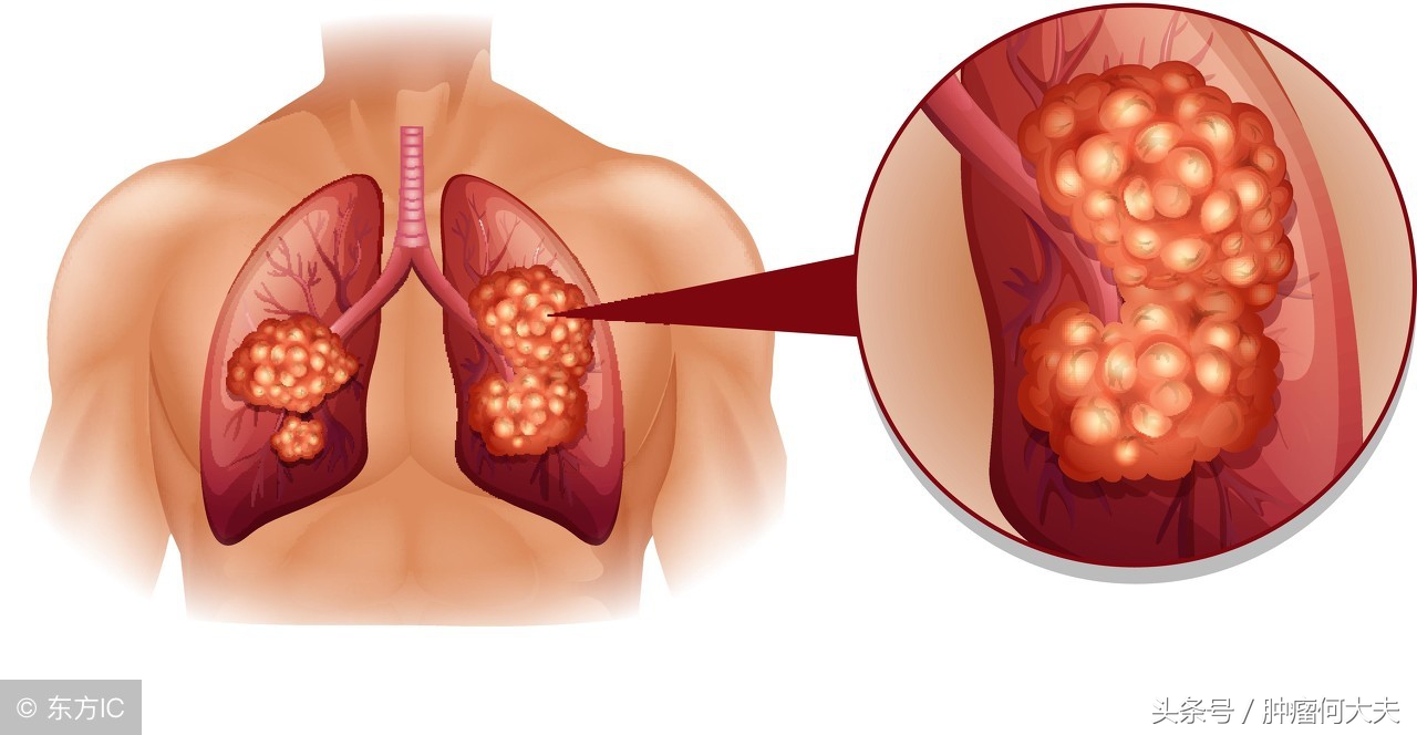肺癌治疗中常用到的“X刀”、“Y刀”等，是什么？效果好吗？