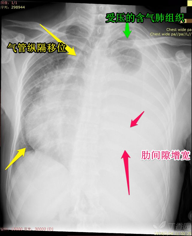 又见白肺，一文教你如何跟患者讲解平片，收藏！