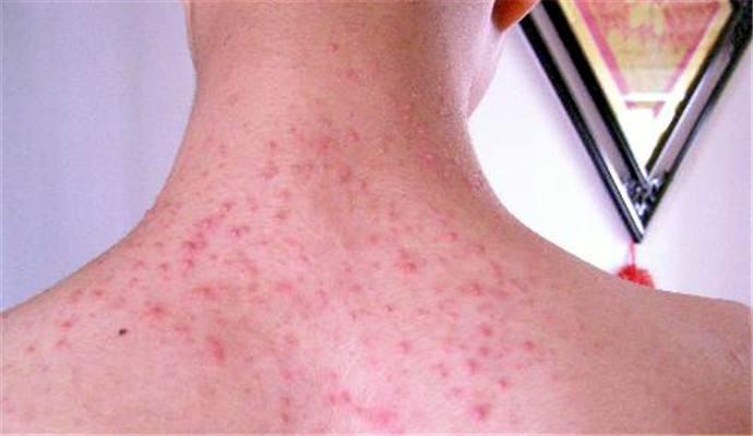 后背油脂粒是螨虫吗,背部螨虫粒和脂肪粒区别