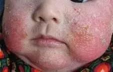 宝宝湿疹康复的全过程,宝宝湿疹不严重也不见好