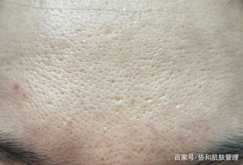 怎么有效的修复脸上的痘坑痘印,什么膏药能够治疗脸上的痘坑痘印