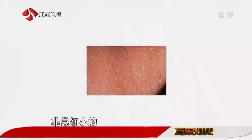 季节更替怎么预防皮肤病,皮肤病痒疹的关注事项