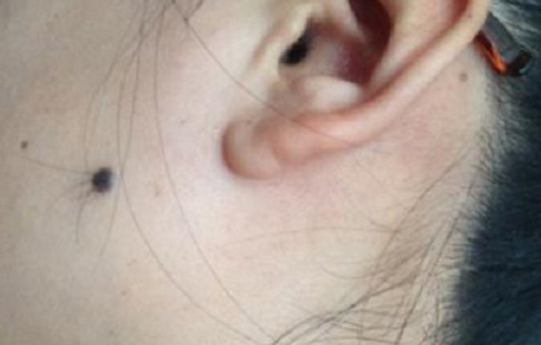 身上黑痣周边变白有危险吗,身上的黑痣能随意处理吗有危害吗