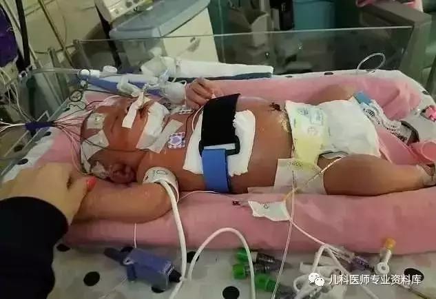 宝宝嘴巴上火的症状,宝宝嘴巴臭是积食还是上火