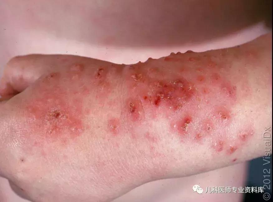 宝宝嘴巴上火的症状,宝宝嘴巴臭是积食还是上火