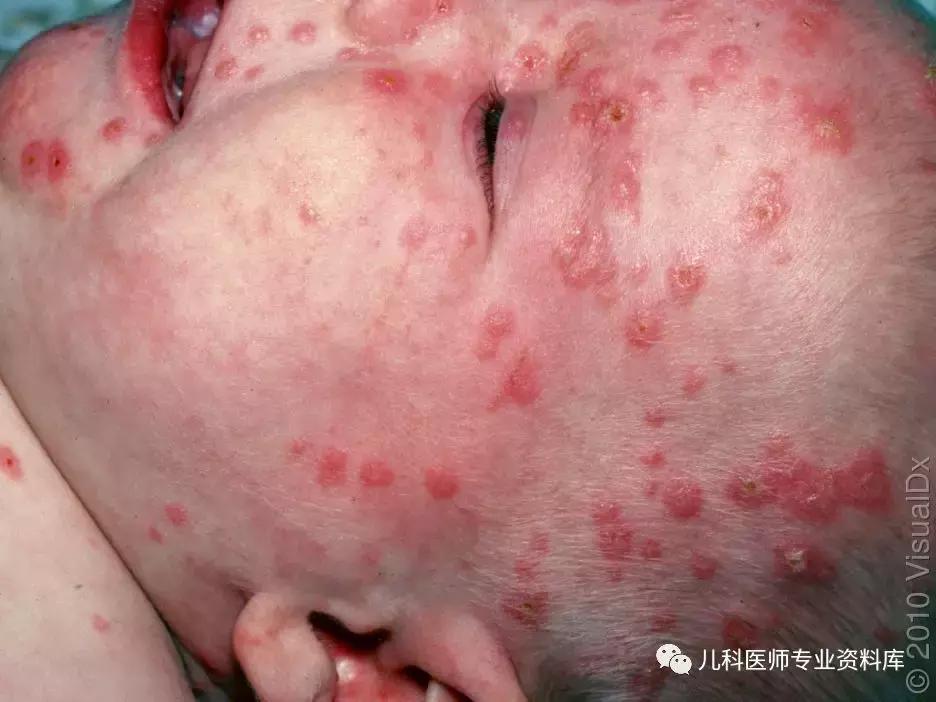 宝宝嘴巴上火的症状,宝宝嘴巴臭是积食还是上火