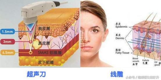 做线雕疼吗说说感受,线雕真实感受