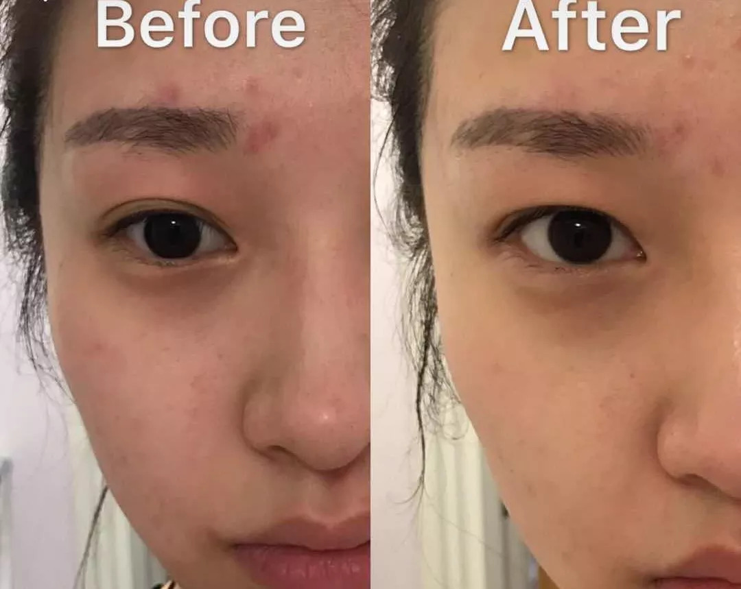 周迅20年前就一脸斑？日本30天击碎顽固斑的好物，快让她用用！