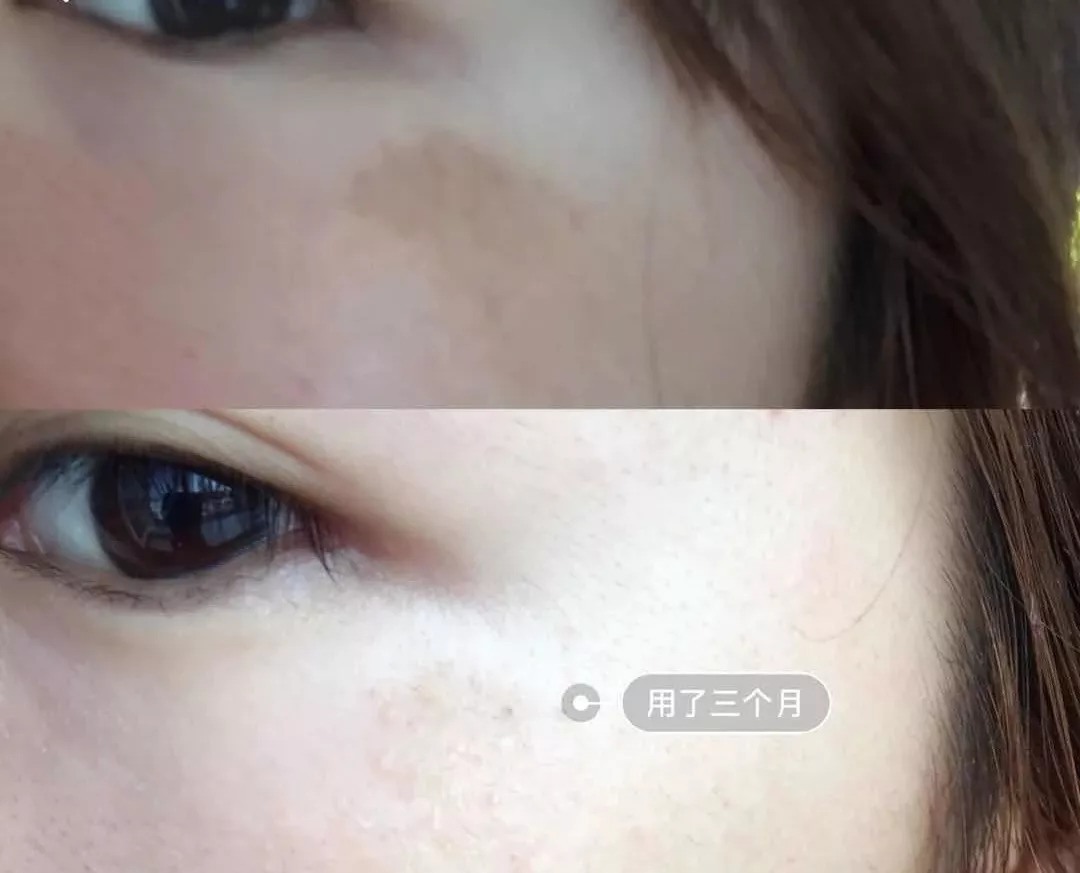 周迅20年前就一脸斑？日本30天击碎顽固斑的好物，快让她用用！