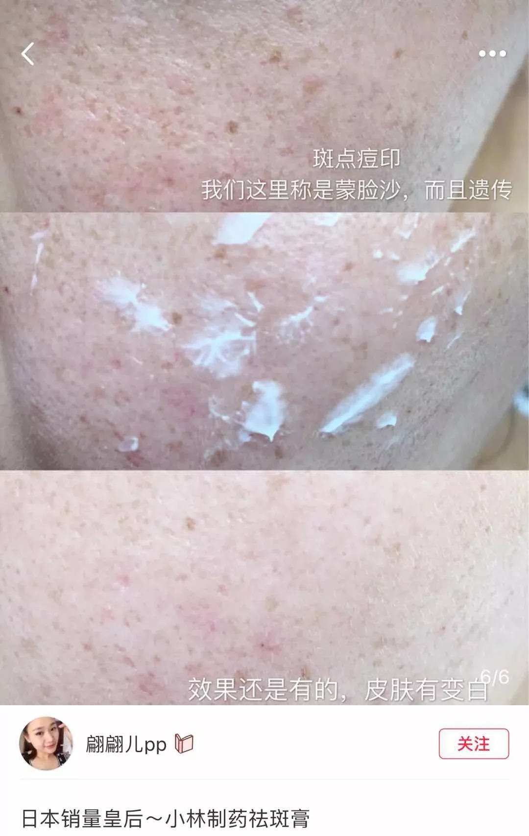 周迅20年前就一脸斑？日本30天击碎顽固斑的好物，快让她用用！