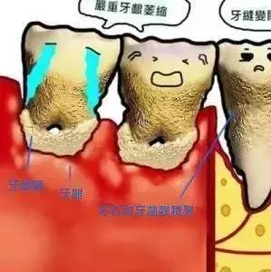 牙周炎最新治疗技术,牙周炎是怎么引起的