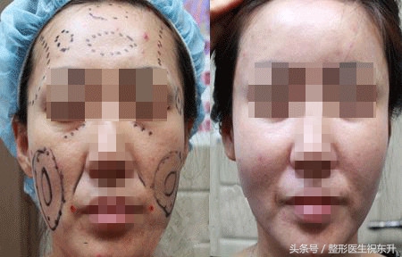 自体脂肪术后关注事项,自体脂肪脸部填充不忌口会怎样