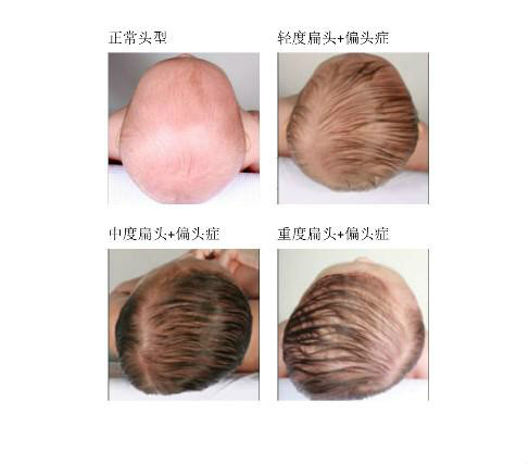 宝宝头型睡偏怎么按摩颈部,三个月婴儿头型睡偏了怎么办