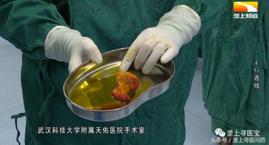 视觉盛宴！速来围观！现场直播腹腔镜胆囊切除术全过程！