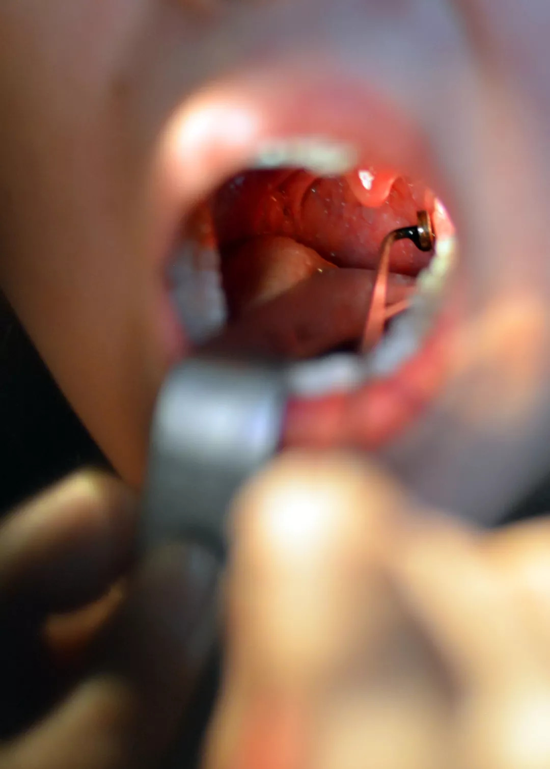 中医扁桃体烙法痛吗,中医烙法治疗扁桃体靠谱吗