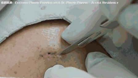 为啥那么多人爱看挤痘,为啥喜欢看挤痘痘