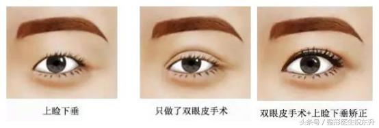 老是感觉上眼皮耷拉怎么回事,老是眼皮跳是什么病