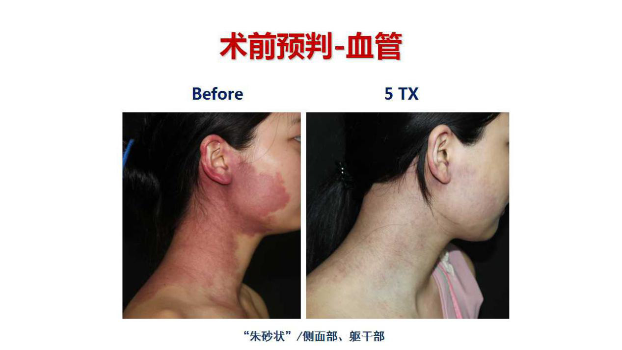 刚刚出生婴儿脸上长了肉痣怎么办,8个月宝宝脸上长雀斑样痣