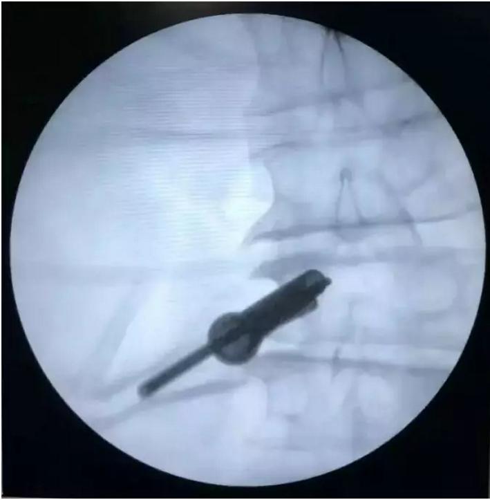 腰椎间盘脱出重度游离患者在郑大二附院成功医治