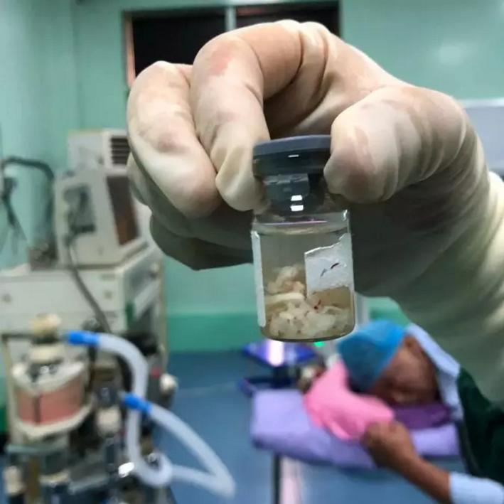 腰椎间盘脱出重度游离患者在郑大二附院成功医治