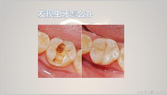 关爱牙齿预防虫牙从小做起,儿童漱口水可以预防虫牙