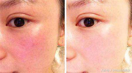 脸皮角质层太薄发红怎么办,脸皮薄有红血丝怎么修复